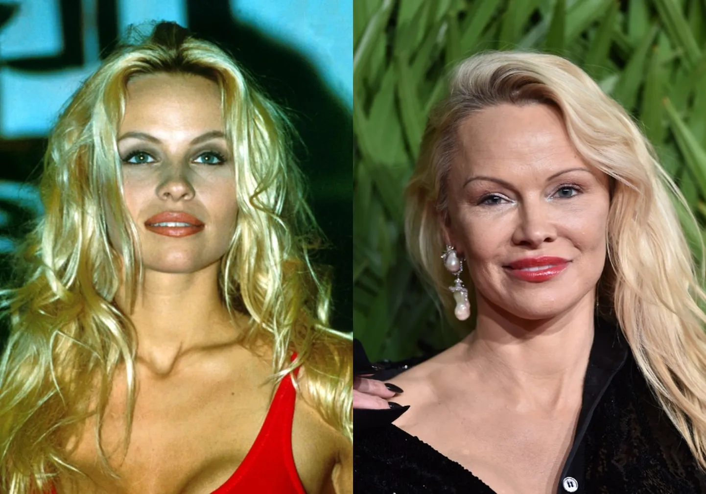 Paljud naisstaarid on aastate jooksul ilulõikuste tõttu totaalselt muutunud. Üks neist on Pamela Anderson (pildid aastast 2000 ja 2018).
