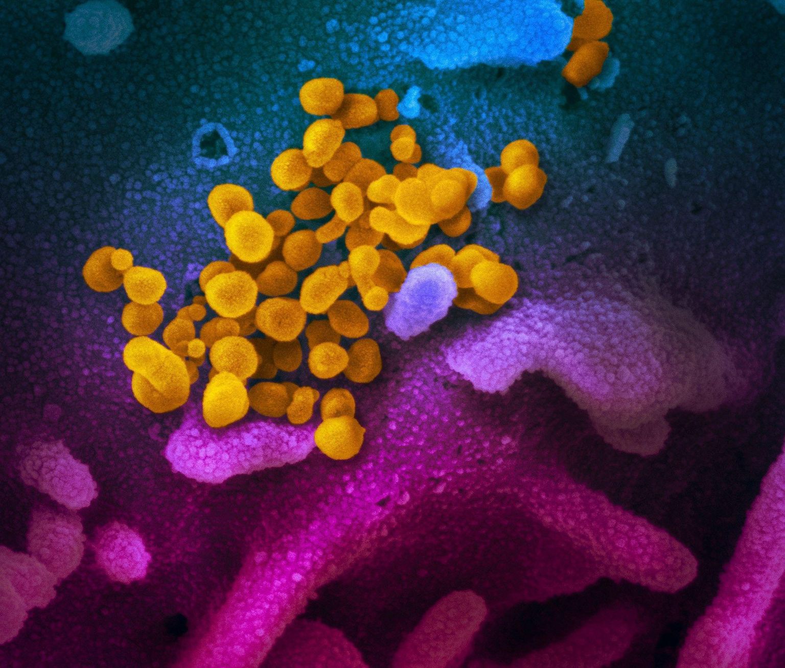 Elektronmikroskoobi all on viirus SARS-CoV-2 (kollane), mis põhjustab haigust Covid-19. Violeti ja purpuriga on rakud.