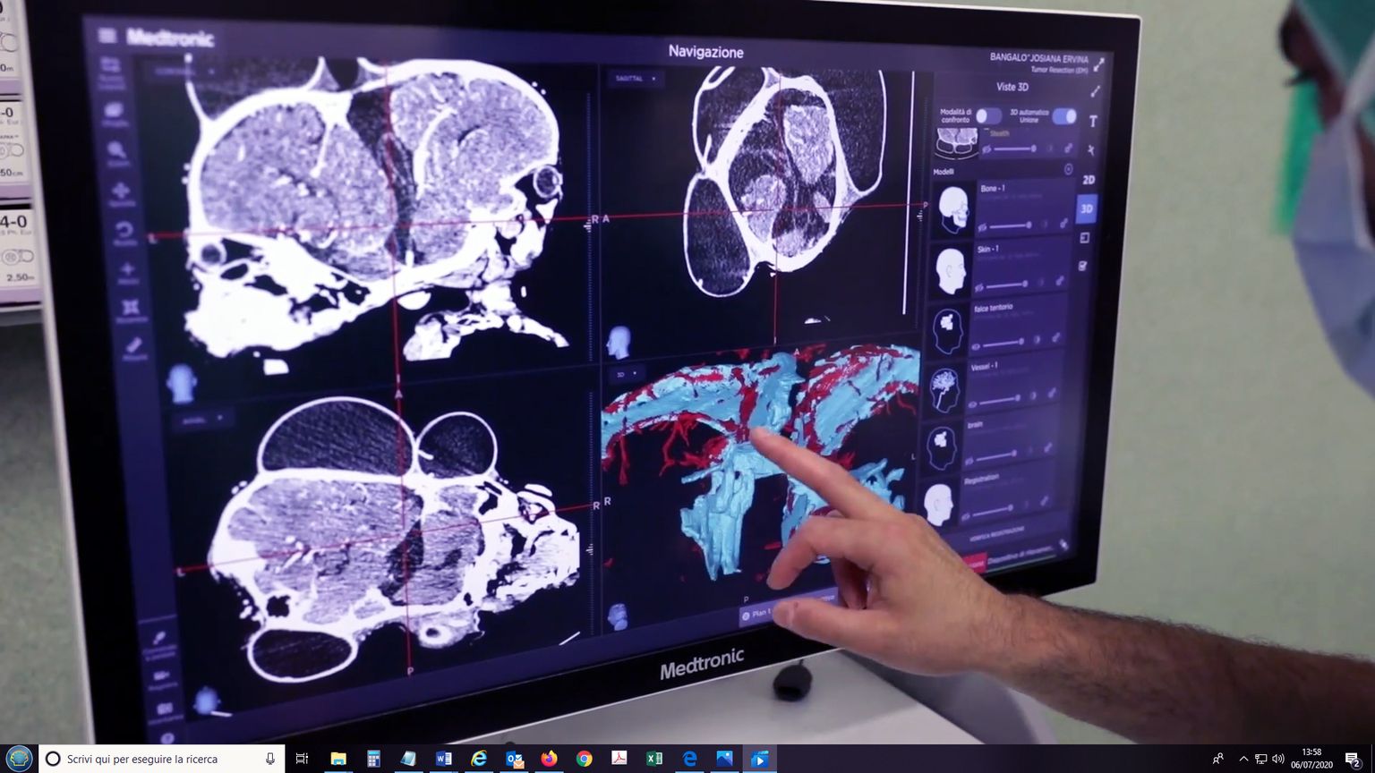 Arst jälgib operatsiooni käigus 3D monitorilt kaheaastaste kaksikute Ervina ja Prefina koljusid, mille eraldamiseks läks Rooma lastehaiglas vaja kolme operatsiooni.