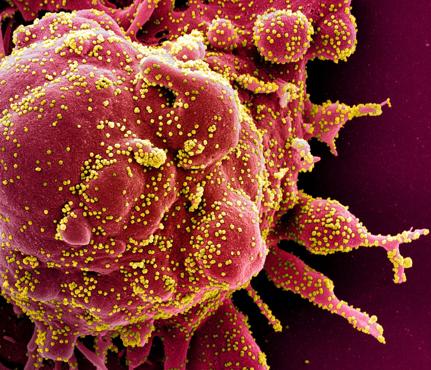 Апоптотическая клетка, инфицированная коронавирусом. Иллюстративное фото.