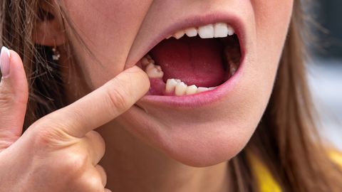 Tarkusehambaid saab edukalt kasutada puuduvate hammaste asendamiseks