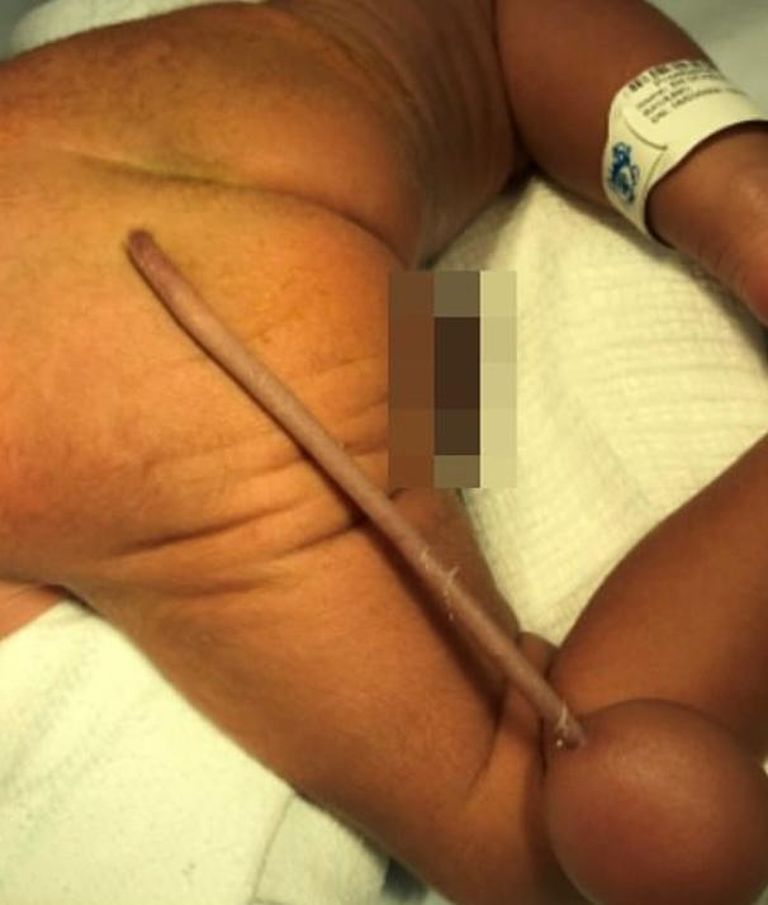 Brasiilia poisil oli sündides 12-sentimeetrine saba.